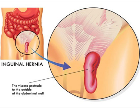 Treatment for Hernia in Mumbai