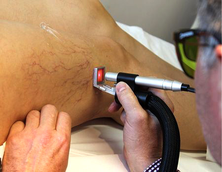 operaie videoclipuri cu laser varicose ginger i vene varicoase